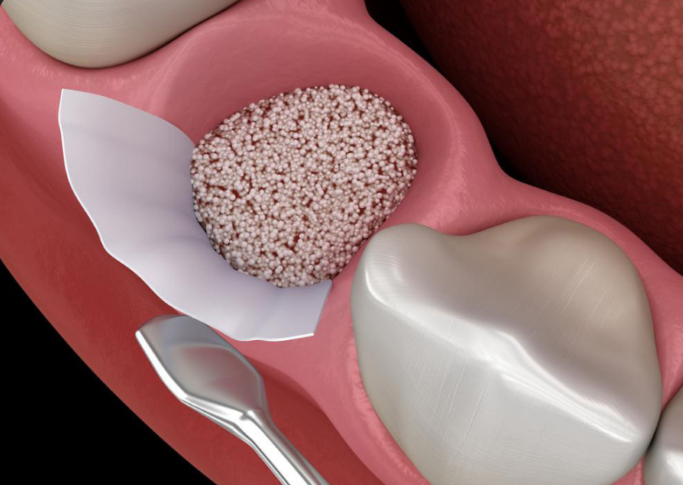 Bone Grafting Masterclass course image